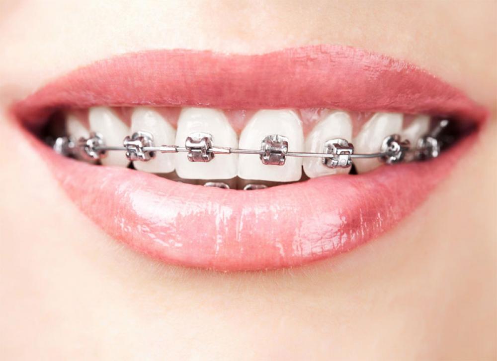 Брекеты и качественные услуги профессионального ортодонта