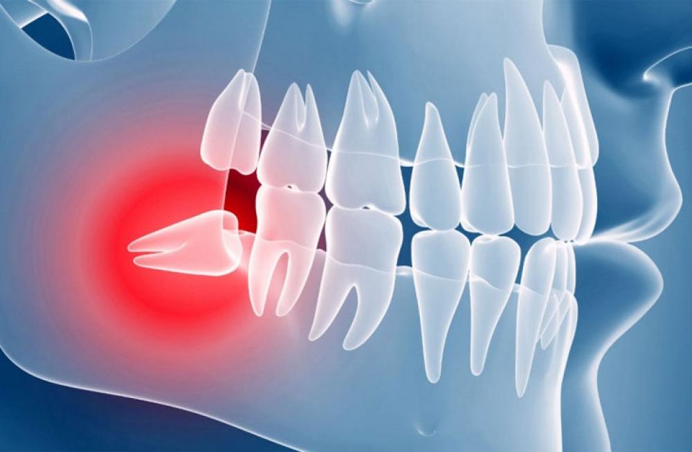 Оперативное удаление зубов мудрости в Черкассах - Julia