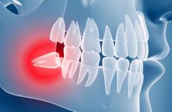 Оперативное удаление зубов мудрости в Черкассах - Julia